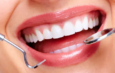 Unlocking Your Perfect Smile: The Power of Dental Veneers